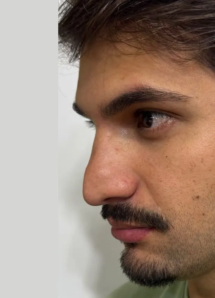 Perfil de paciente antes da harmonização de nariz e queixo