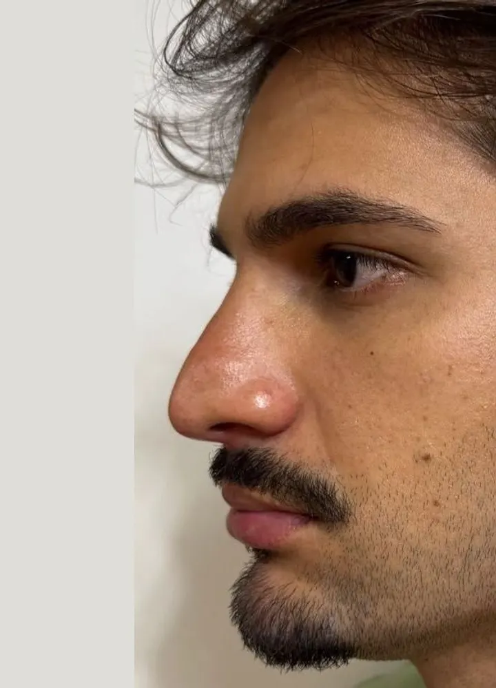 Perfil do mesmo paciente depois da harmonização de nariz e queixo