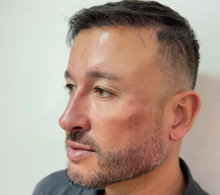 Perfil do mesmo paciente depois do procedimento