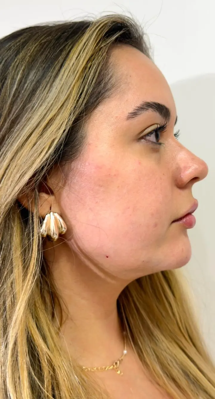 Perfil da mesma paciente depois do procedimento